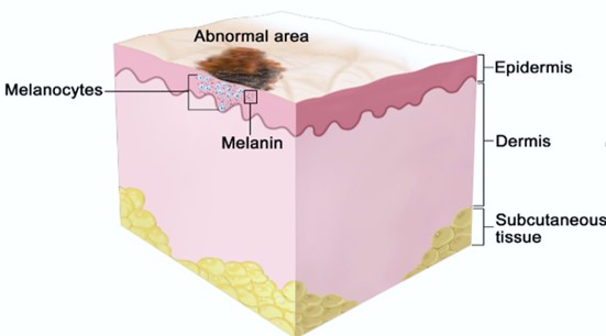 melanoma